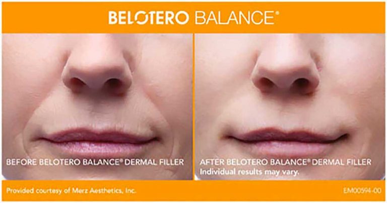 Белотеро до и после фото Belotero Facial Filler Injectable Treatment Lexington KY - Bemedispa