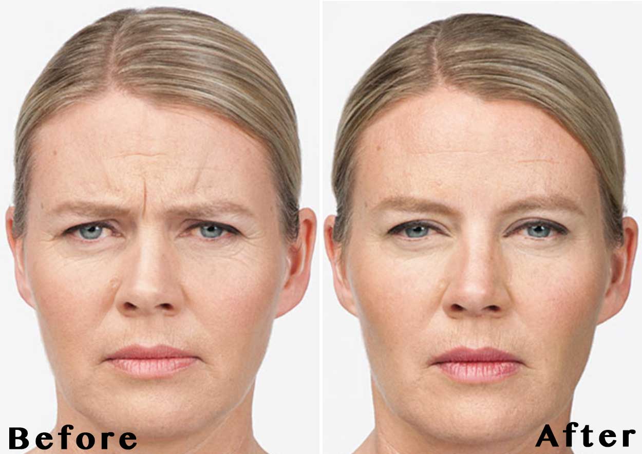 Ботокс до и после фото лицо 30 лет